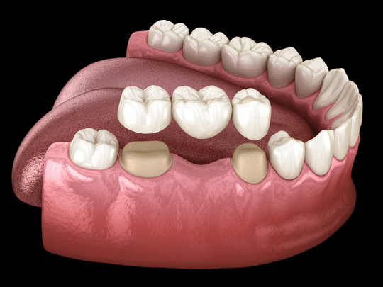 dental bridges