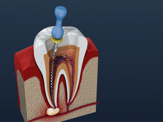 root canal